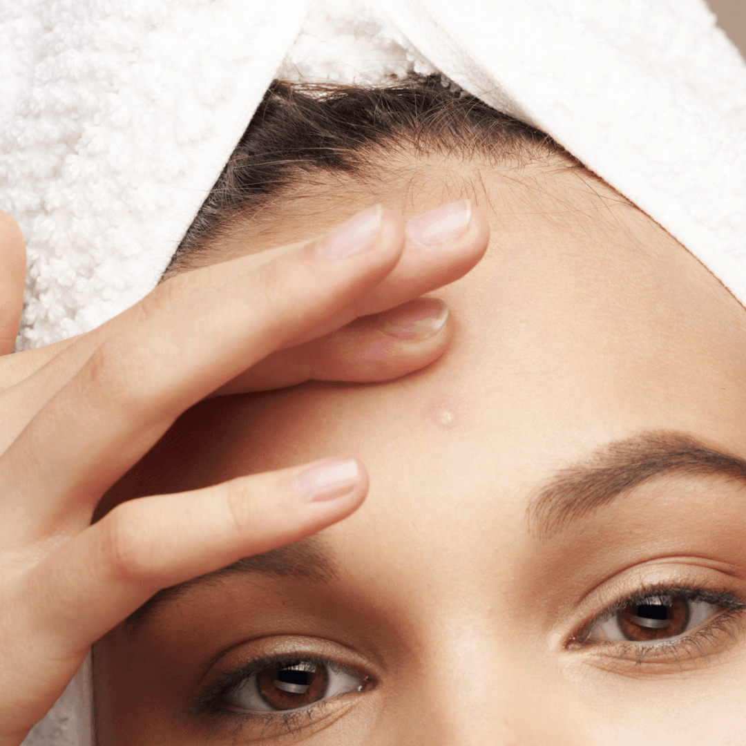 acne behandeling bij PUUR Huidinstituut PUUR Natural Skin Breda